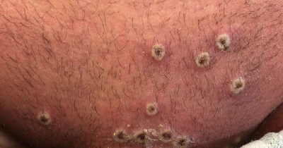 España ya cuenta con 59 casos de viruela del mono y comprará vacunas