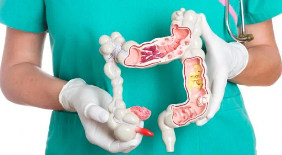 La alimentación influye en el cáncer colorrectal